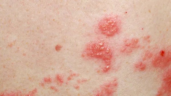 治痤疮花多少钱