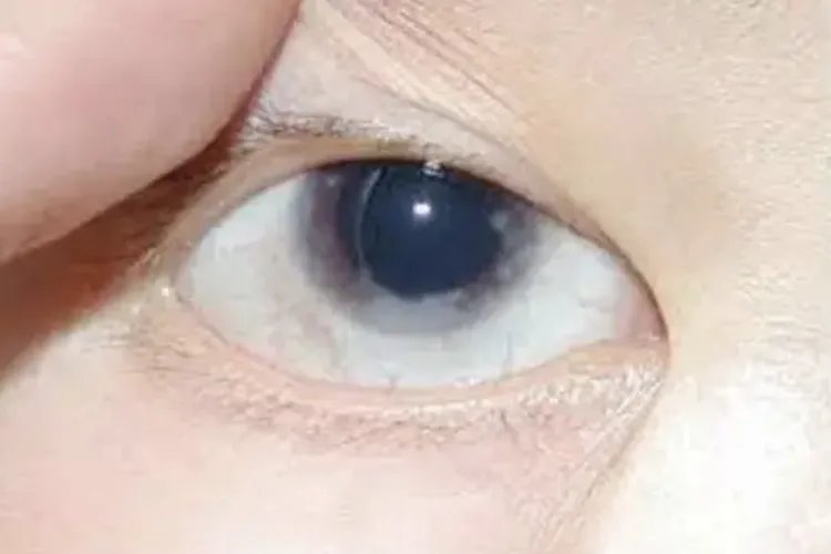 青光眼的早期症状是什么样子