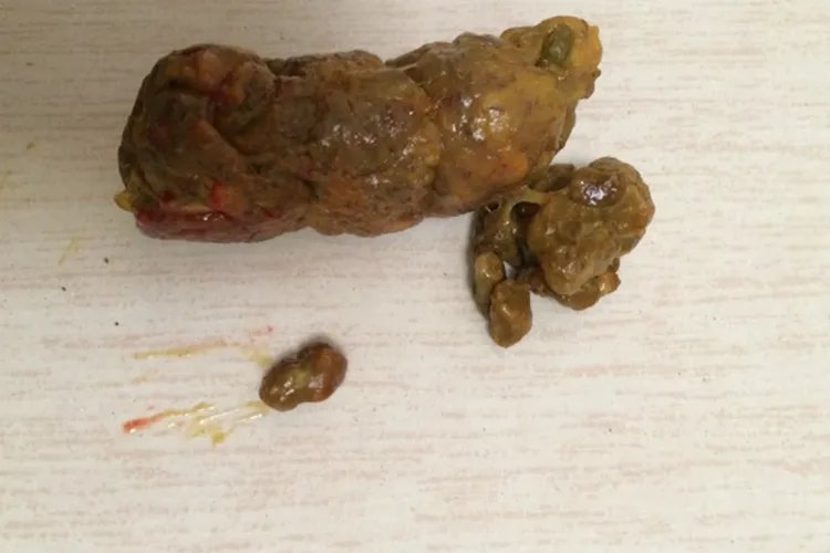 直肠癌大便图片