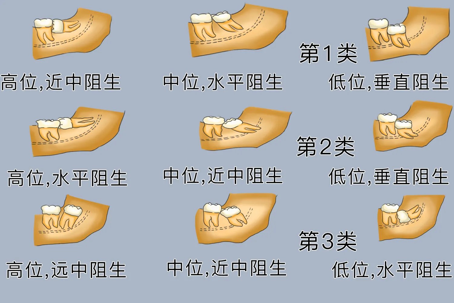 最难拔的智齿图