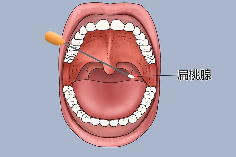 咽拭子所取部位图片