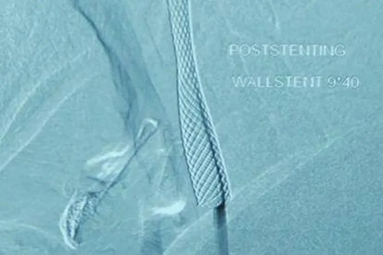 颈动脉支架图片