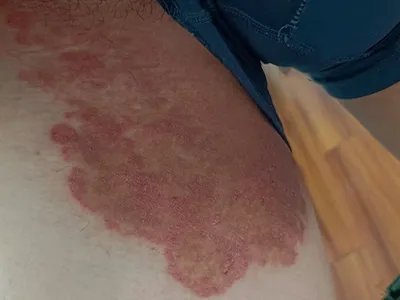 湿疹大腿症状图片