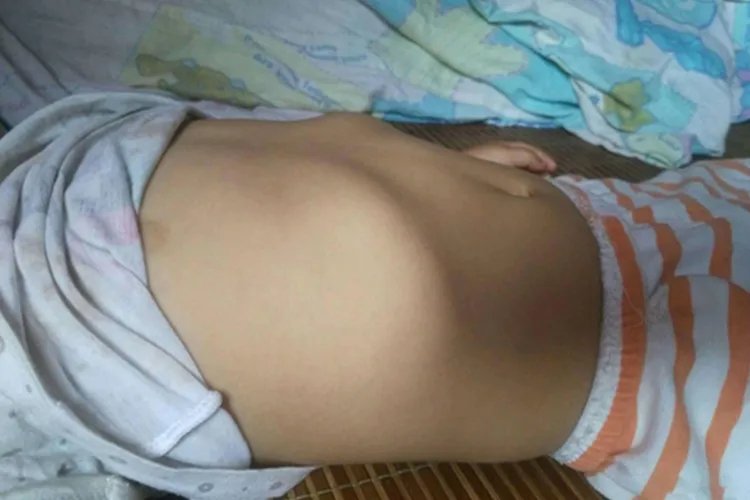 小孩子肋骨外翻图片