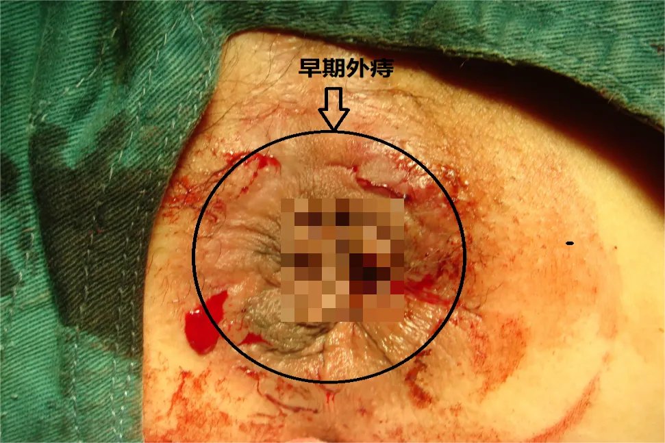 早期外痔图片