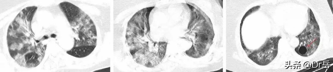 为什么湖北新增病例突增14840例？临床诊断病例是什么？