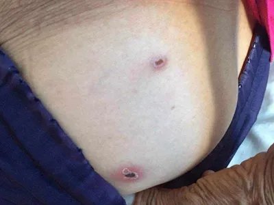 恙虫病焦痂图片