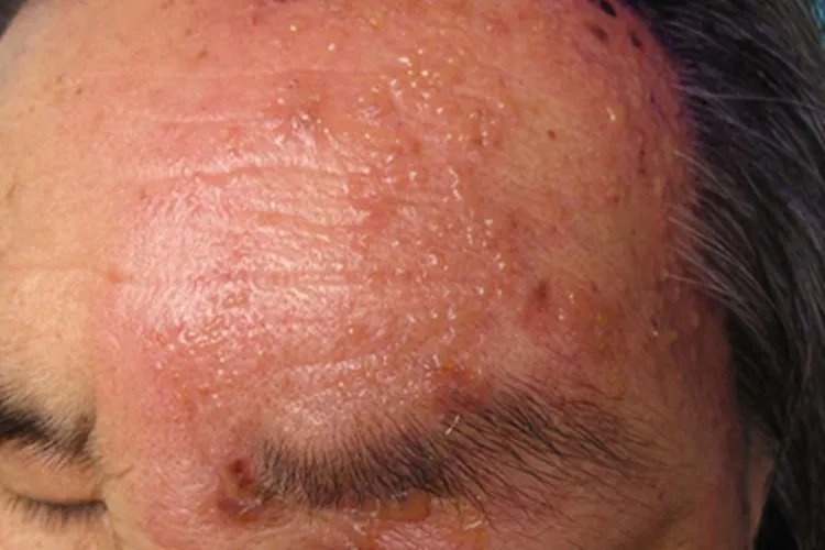 带状疱疹小水疱图片