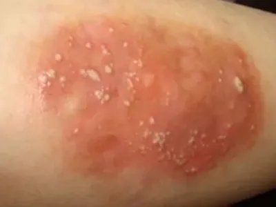 湿疹大腿症状图片