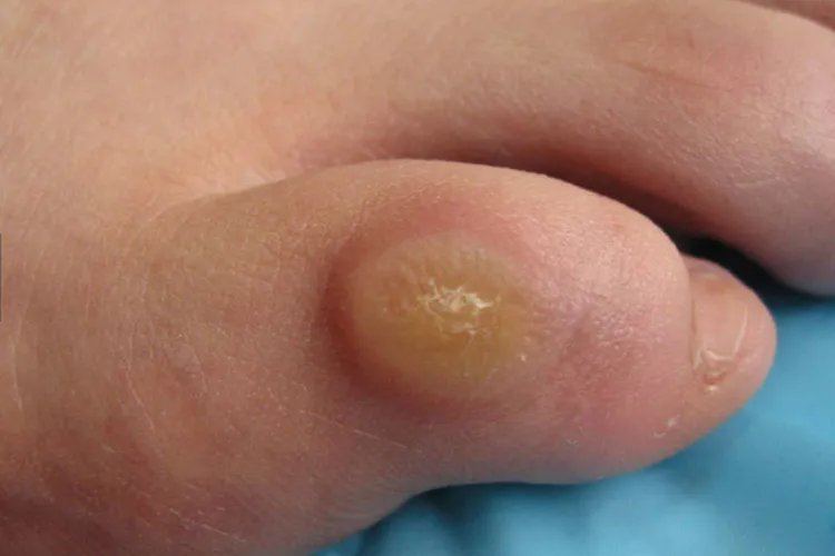 鸡眼图片大全大图