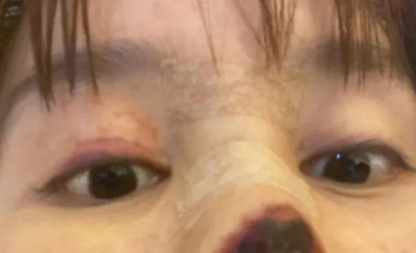 女星整容失败鼻头坏死，损失240万欲轻生，门诊是否需要承担责任？