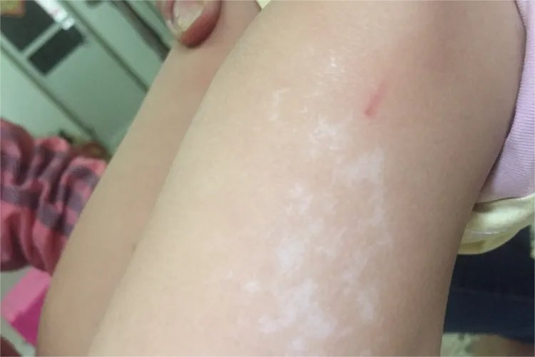 大腿汗斑癣图片大全