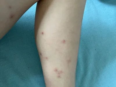 跳蚤叮咬红点图片