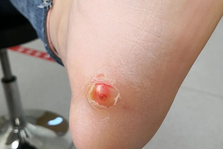 鸡眼图片大全大图