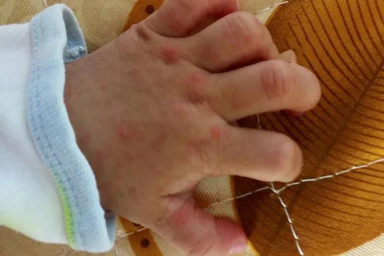 手足口病的初期症状图片