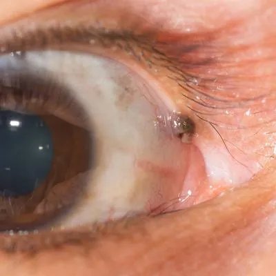 视网膜脱落需要做哪些检查