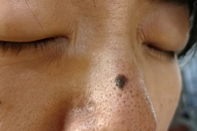 黑素细胞痣鼻部黑痣图片