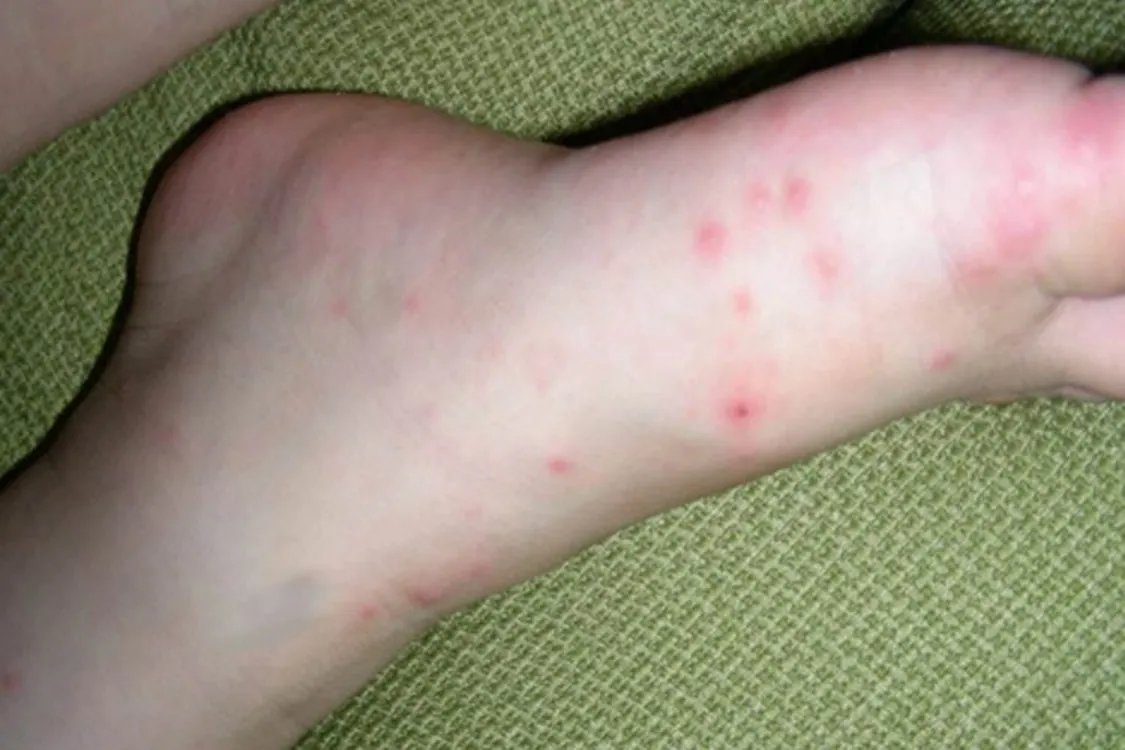 手足口病疹子图片