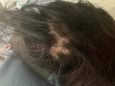 拔毛癖头皮症状图片