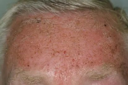 额头上长满了密密麻麻的丘疹图片