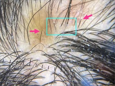 拔毛癖头皮症状图片
