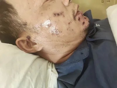 带状疱疹面部黑痂图片