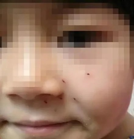 女童脸被老师扎洞 只因算数没算好