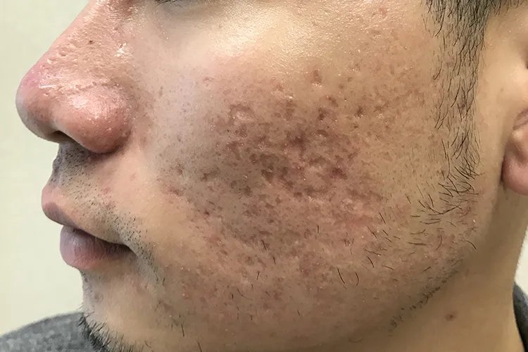 脸上长痘痘位置图解