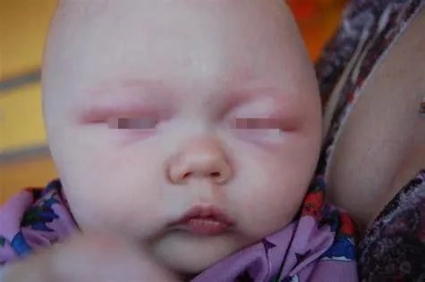 宝宝幼儿急疹初期图片