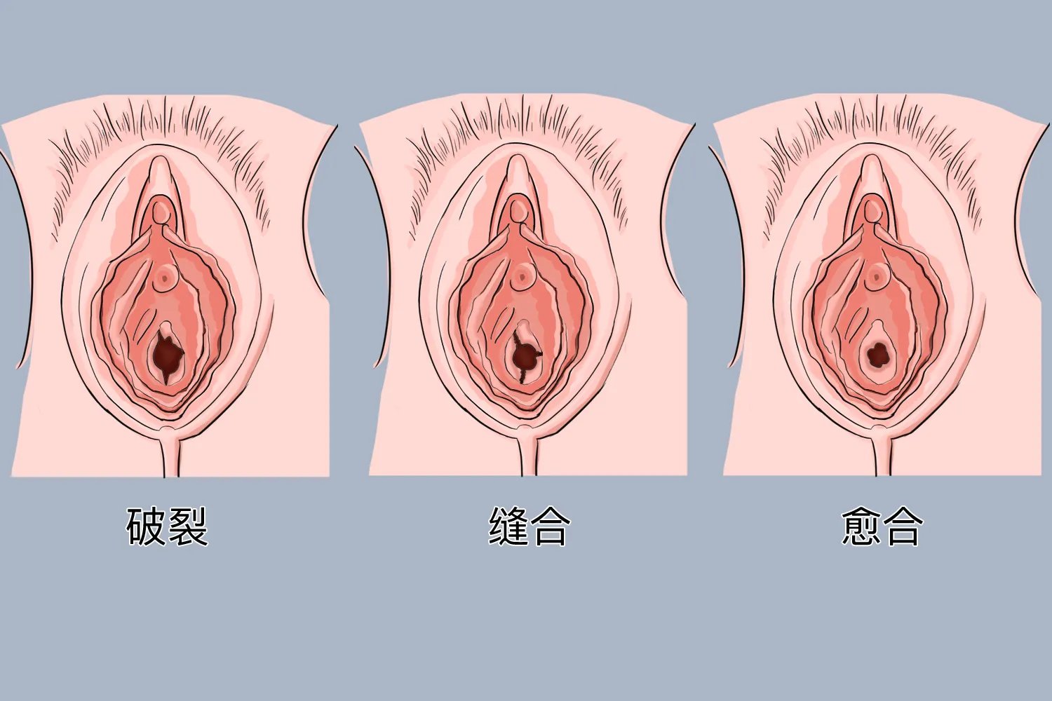 处女膜修复图片