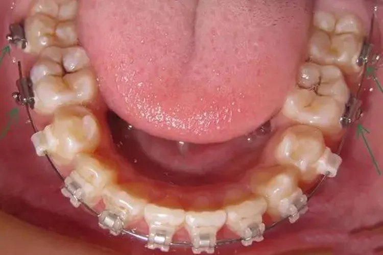 大牙牙套的图片