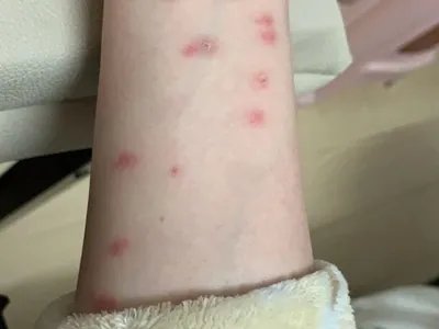 跳蚤叮咬红点图片