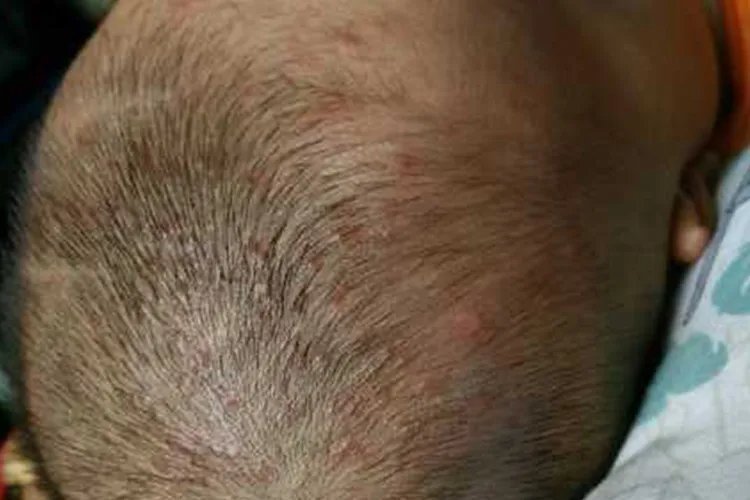 小孩毛囊炎图片