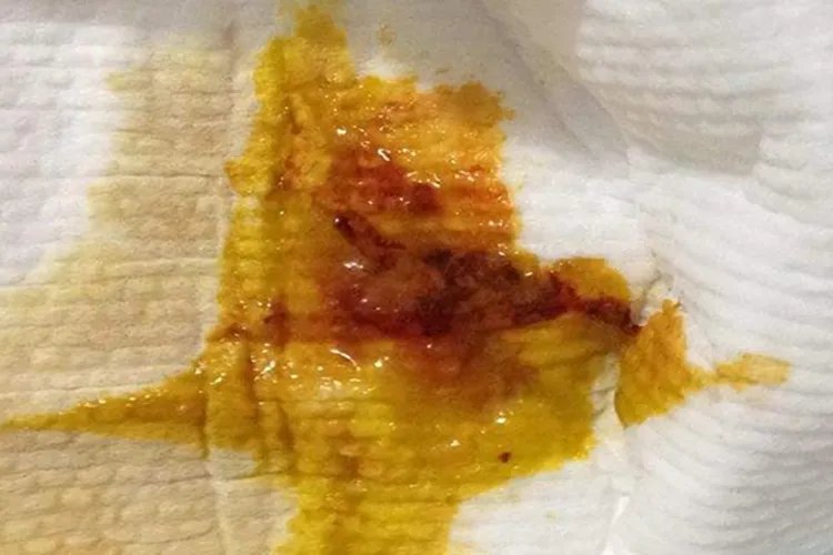 直肠癌大便图片