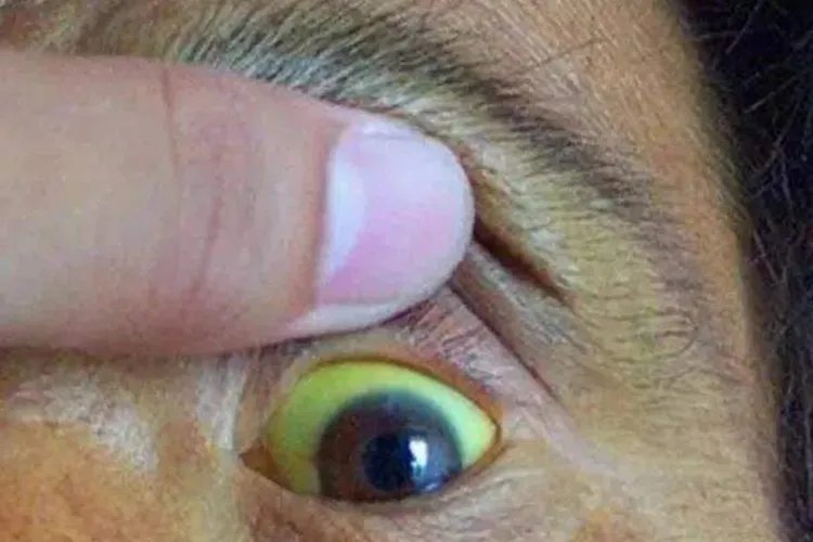 胆囊炎的症状是什么样的