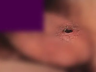 恙虫病焦痂图片