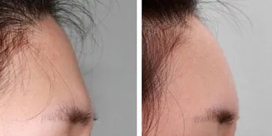 额部填充术后如何护理