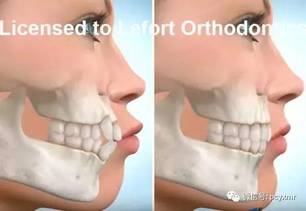 拔智齿真的可以瘦脸吗？有何依据？