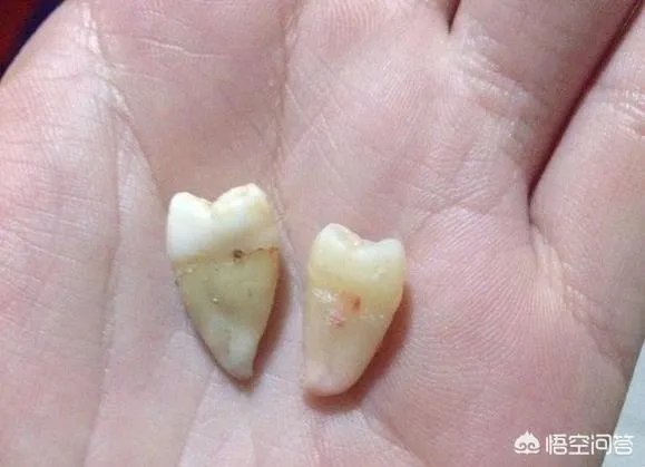 拔智齿真的可以瘦脸吗？有何依据？