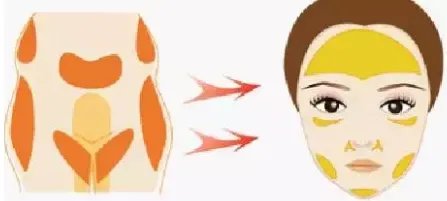 千万不要做自体脂肪填充全脸