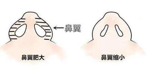 鼻翼缩小前后对比