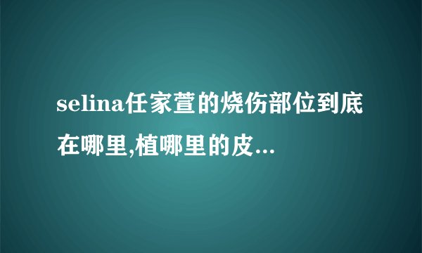 selina任家萱的烧伤部位到底在哪里,植哪里的皮为什么要剪头发？