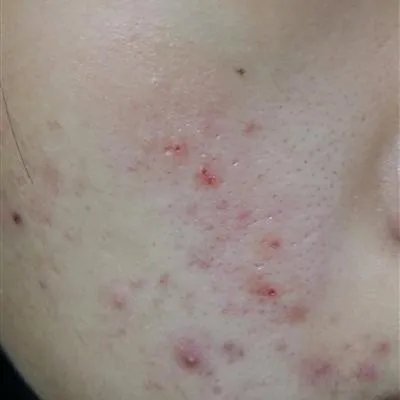 医院治疗痤疮怎么样