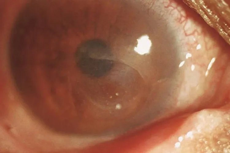 角膜炎初期症状图片