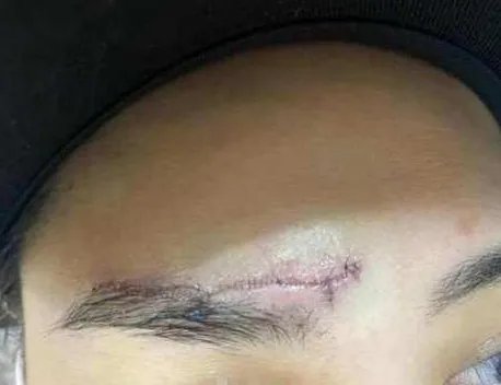 阿娇晒伤口照片,伤势恢复的怎样了?