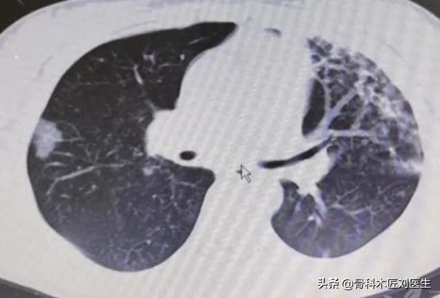 谁能解释一下昨天19号湖北省的新增病例统计是如何计算的，一头雾水？
