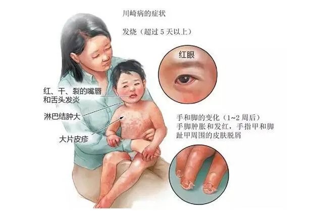 如何看待英国多个重症监护病房儿童身上出现罕见病，是新冠出现变异了么？