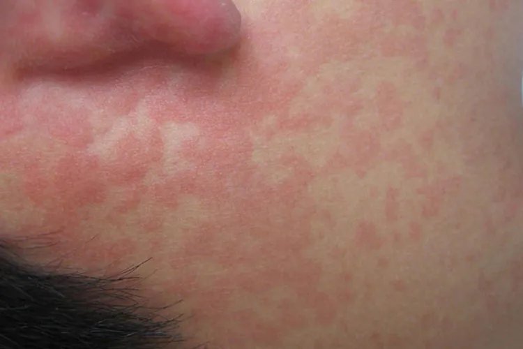 婴儿麻疹的症状图片