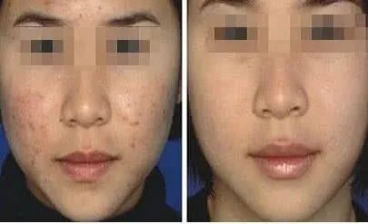 像素激光祛痘价格