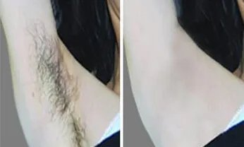 全身激光脱毛要多少钱